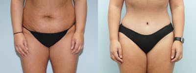 Tummy Tuck Before & After Gallery - Patient 121817999 - Image 1
