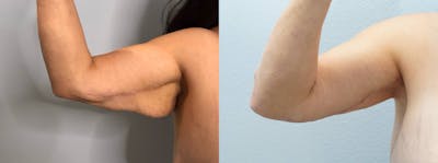Arm Lift Before & After Gallery - Patient 121818147 - Image 1
