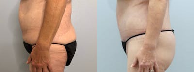 Brazilian Butt Lift Before & After Gallery - Patient 121818161 - Image 1