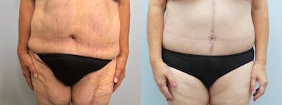 Body Lift Before & After Gallery - Patient 121818179 - Image 1