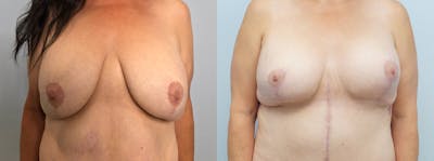 Breast Revision Before & After Gallery - Patient 121818244 - Image 1