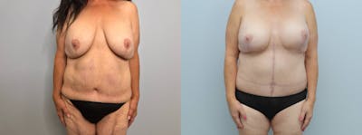Mommy Makeover Before & After Gallery - Patient 121818343 - Image 1