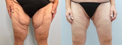 Thigh Lift Before & After Gallery - Patient 121818366 - Image 1