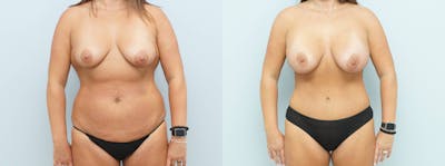 Mommy Makeover Before & After Gallery - Patient 122052351 - Image 1