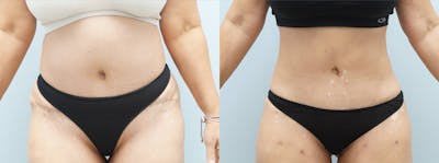 Liposuction Before & After Gallery - Patient 122052798 - Image 1