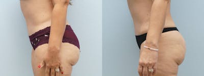 Brazilian Butt Lift Before & After Gallery - Patient 122052811 - Image 1