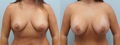 Breast Augmentation Before & After Gallery - Patient 121816085 - Image 1