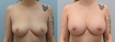 Breast Augmentation Before & After Gallery - Patient 123012553 - Image 1