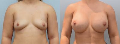 Breast Augmentation Before & After Gallery - Patient 123012554 - Image 1