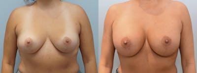 Breast Augmentation Before & After Gallery - Patient 123012555 - Image 1