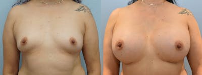 Breast Augmentation Before & After Gallery - Patient 123012556 - Image 1