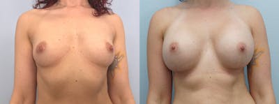 Breast Augmentation Before & After Gallery - Patient 123012557 - Image 1