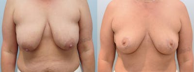Breast Lift Before & After Gallery - Patient 123012773 - Image 1