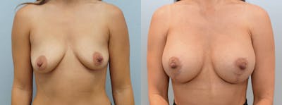 Breast Lift With Implants Before & After Gallery - Patient 123013182 - Image 1