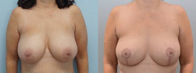 Breast Reduction Before & After Gallery - Patient 123013507 - Image 1