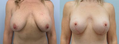 Breast Revision Before & After Gallery - Patient 123014178 - Image 1