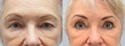 Eyelid Surgery Before & After Gallery - Patient 123014500 - Image 1