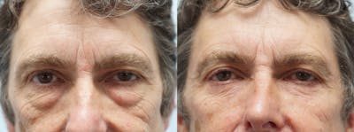Eyelid Surgery Gallery - Patient 123014501 - Image 1