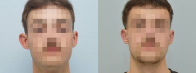 Otoplasty Before & After Gallery - Patient 123014830 - Image 1