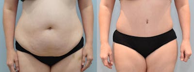 Tummy Tuck Before & After Gallery - Patient 123017847 - Image 1