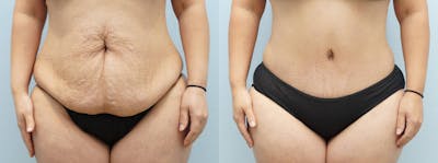 Tummy Tuck Before & After Gallery - Patient 123017848 - Image 1