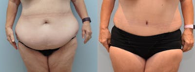 Tummy Tuck Before & After Gallery - Patient 123018405 - Image 1