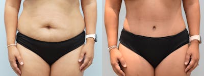 Tummy Tuck Before & After Gallery - Patient 123018406 - Image 1