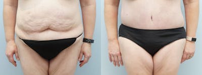 Tummy Tuck Before & After Gallery - Patient 123018407 - Image 1