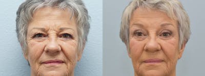 Brow Lift Before & After Gallery - Patient 123019023 - Image 1