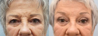 Eyelid Surgery Before & After Gallery - Patient 123019513 - Image 1