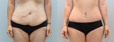 Body Lift Before & After Gallery - Patient 123019878 - Image 1