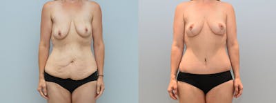 Mommy Makeover Before & After Gallery - Patient 123019895 - Image 1