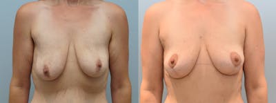 Breast Lift Before & After Gallery - Patient 123019945 - Image 1