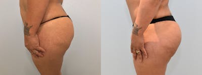 Brazilian Butt Lift Before & After Gallery - Patient 123127123 - Image 1