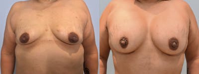 Breast Augmentation Before & After Gallery - Patient 123127145 - Image 1