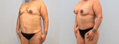 Mommy Makeover Before & After Gallery - Patient 123127162 - Image 1