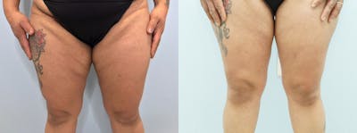 Thigh Lift Before & After Gallery - Patient 123127176 - Image 1