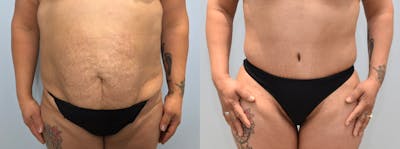 Tummy Tuck Before & After Gallery - Patient 123127197 - Image 1