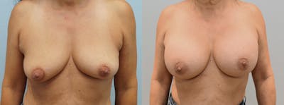 Breast Augmentation Before & After Gallery - Patient 142681402 - Image 1