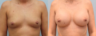 Breast Augmentation Before & After Gallery - Patient 142681416 - Image 1
