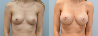 Breast Augmentation Before & After Gallery - Patient 142681420 - Image 1