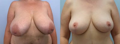 Breast Reduction Before & After Gallery - Patient 142681423 - Image 1