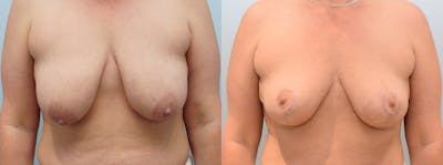 Breast Lift Before & After Gallery - Patient 142681440 - Image 1