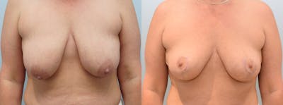Breast Lift Before & After Gallery - Patient 142681440 - Image 1
