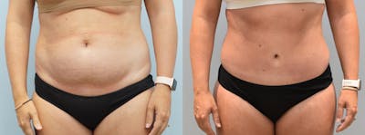 Tummy Tuck Before & After Gallery - Patient 142681443 - Image 1