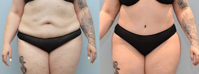 Tummy Tuck Before & After Gallery - Patient 142681452 - Image 1