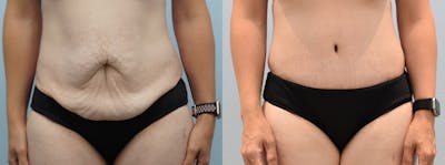 Tummy Tuck Before & After Gallery - Patient 142681451 - Image 1