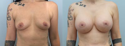 Breast Augmentation Before & After Gallery - Patient 142926627 - Image 1