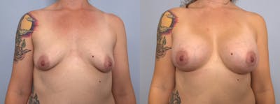 Breast Augmentation Before & After Gallery - Patient 142926626 - Image 1