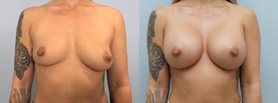 Breast Augmentation Before & After Gallery - Patient 142926640 - Image 1